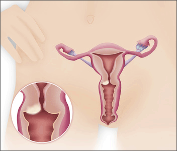 子宮頸がんの症状と罹患の可能性…オリモノ異変や不正出血は婦人科へ