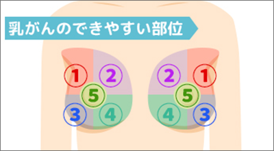 乳がんの症状と特徴 原因となる要素とは Sbi損保のがん保険